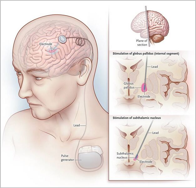 File:Electrode-Implantation-for-Deep-Brain-Stimulation1.jpg