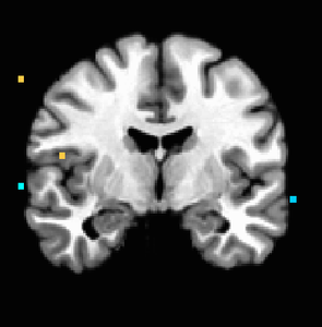 Figure 4. P<0.001 uncorrected; anterior insula activation holds on right side.