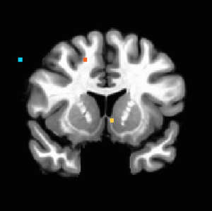 Figure 2. P<0.001 uncorrected, showing evidence of ventral striatal activation with increasing iconicness of the landscape.