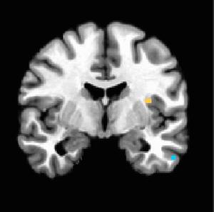 Figure 7. P<0.001 uncorrected, anterior insula activation remains strong on the left side in response to increasingly destructive land uses.