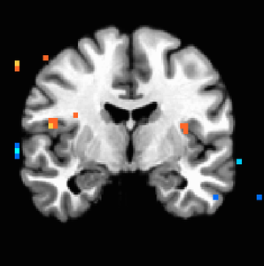 Figure 3. P<0.005 uncorrected, showing increased bilateral anterior insula activation with increasingly destructive land uses.