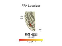 Example localized adolescent right FFA.