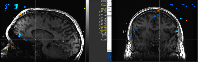 Figure 11. Subject BH.